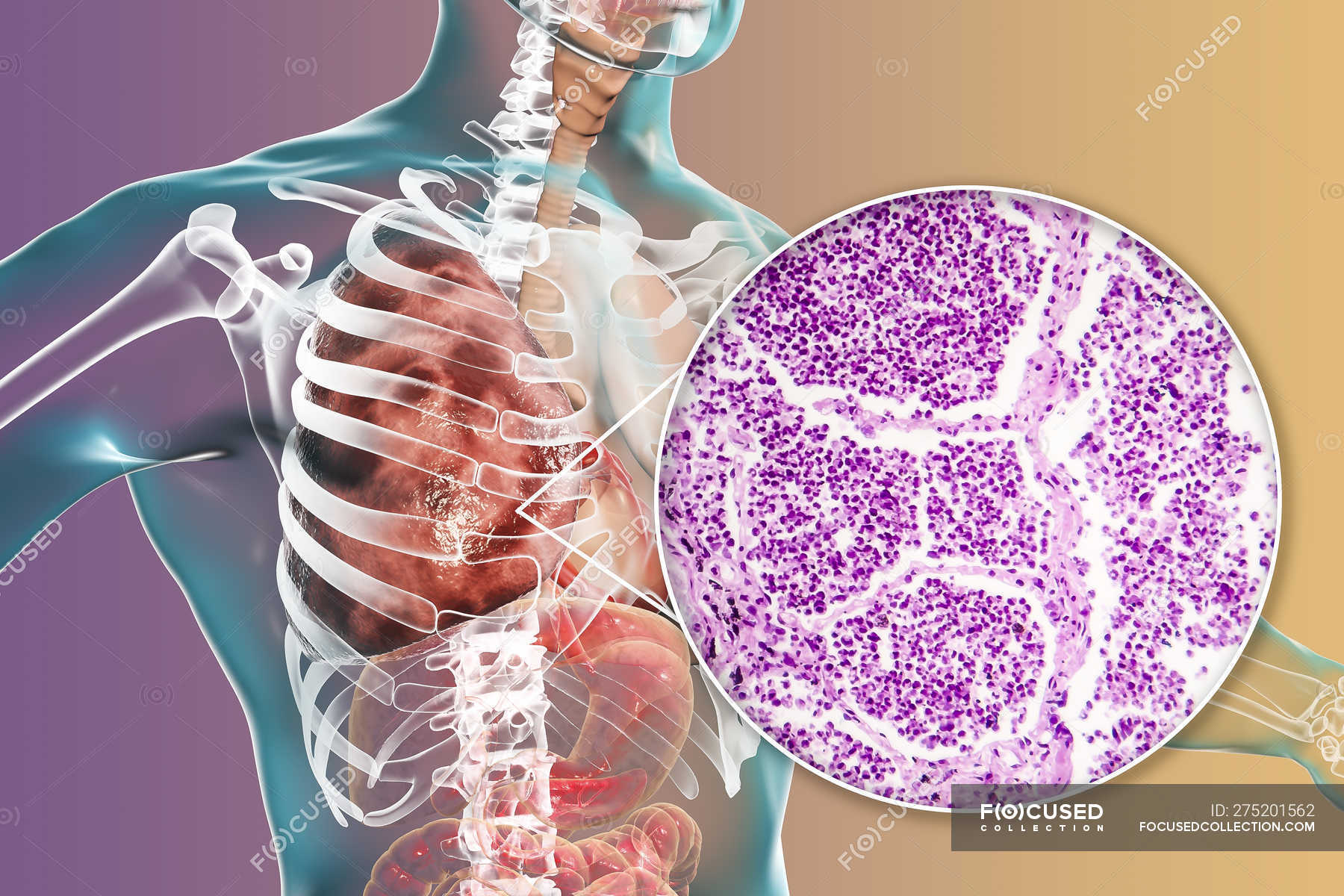 Lobar pneumonia in stage of grey hepatisation or late consolidation ...