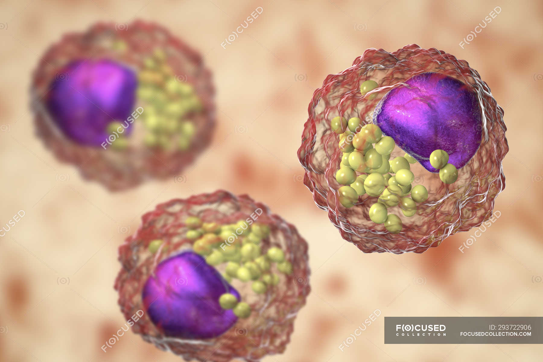 Macrophage foam cells containing lipid droplets, digital illustration