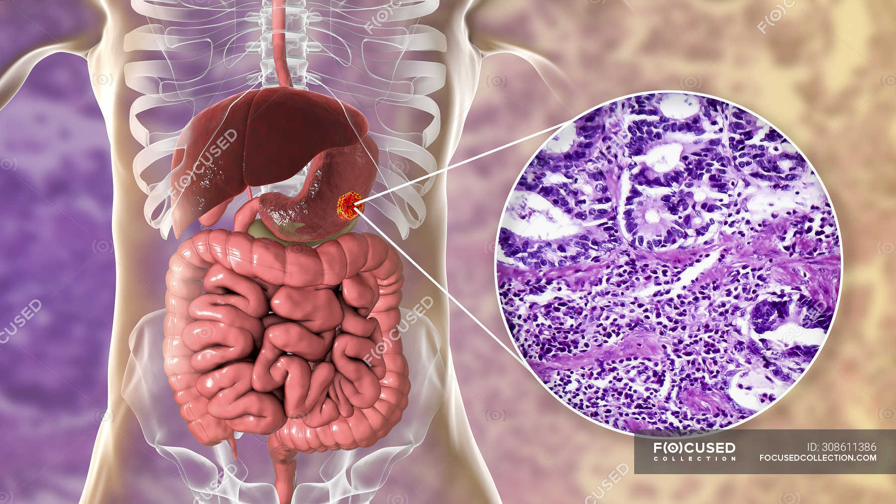 Human Stomach Adenocarcinoma Computer Illustration And Light Micrograph Tumor Unhealthy