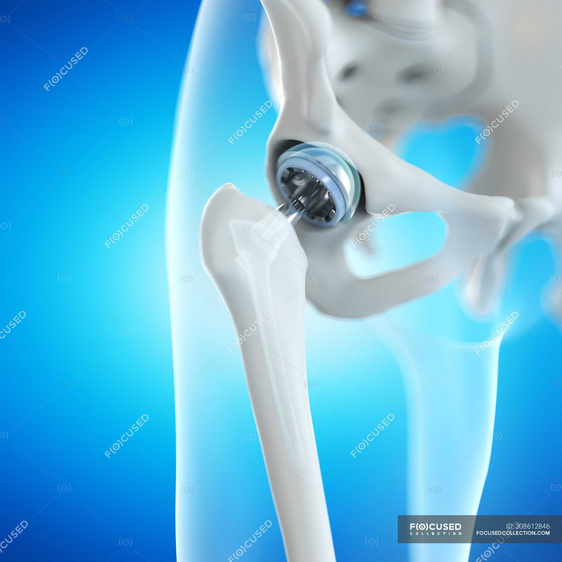 Orthopedics hip replacement on blue background, digital illustration ...