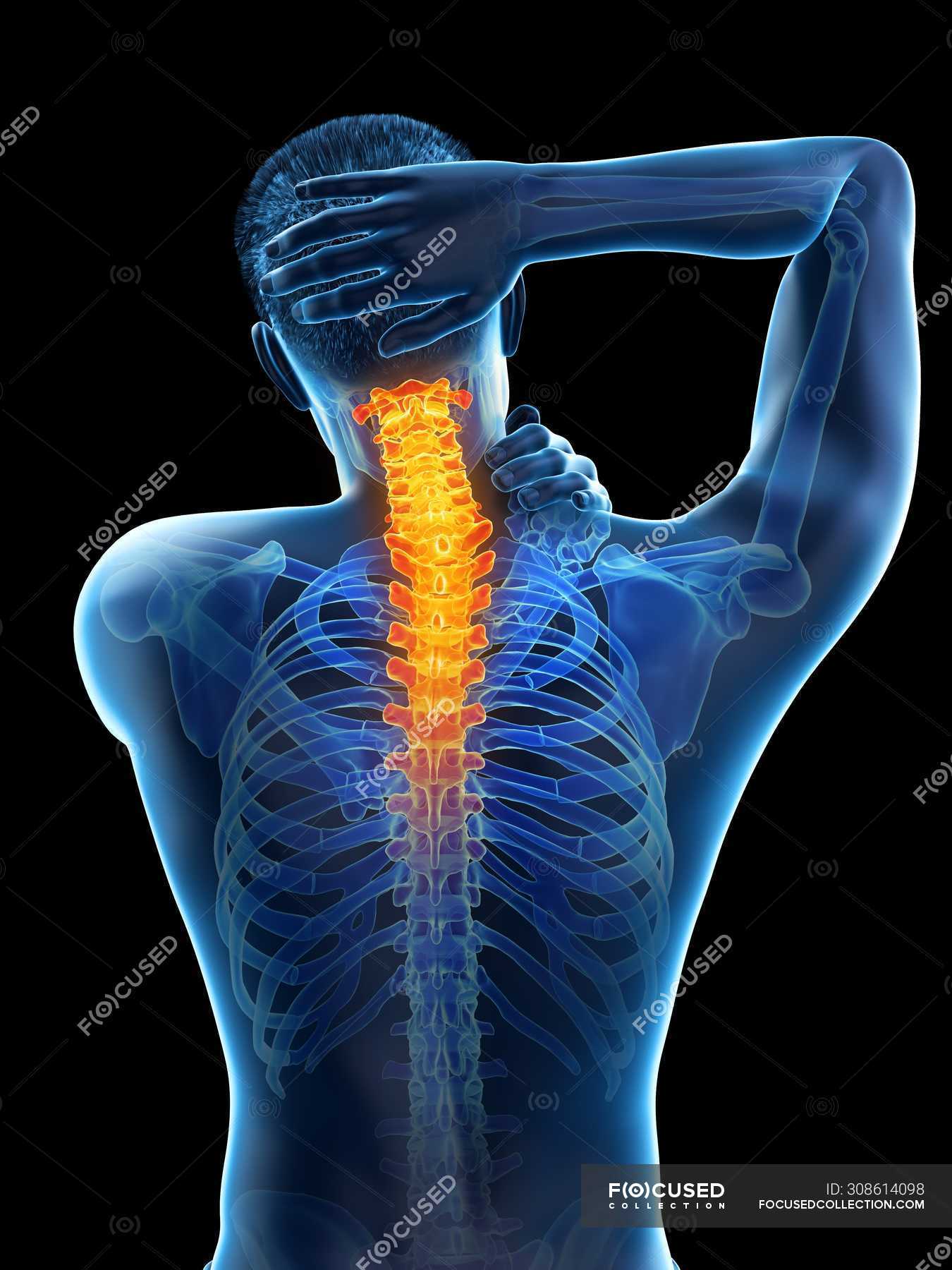 Male body in rear view with visible neck pain, conceptual illustration ...