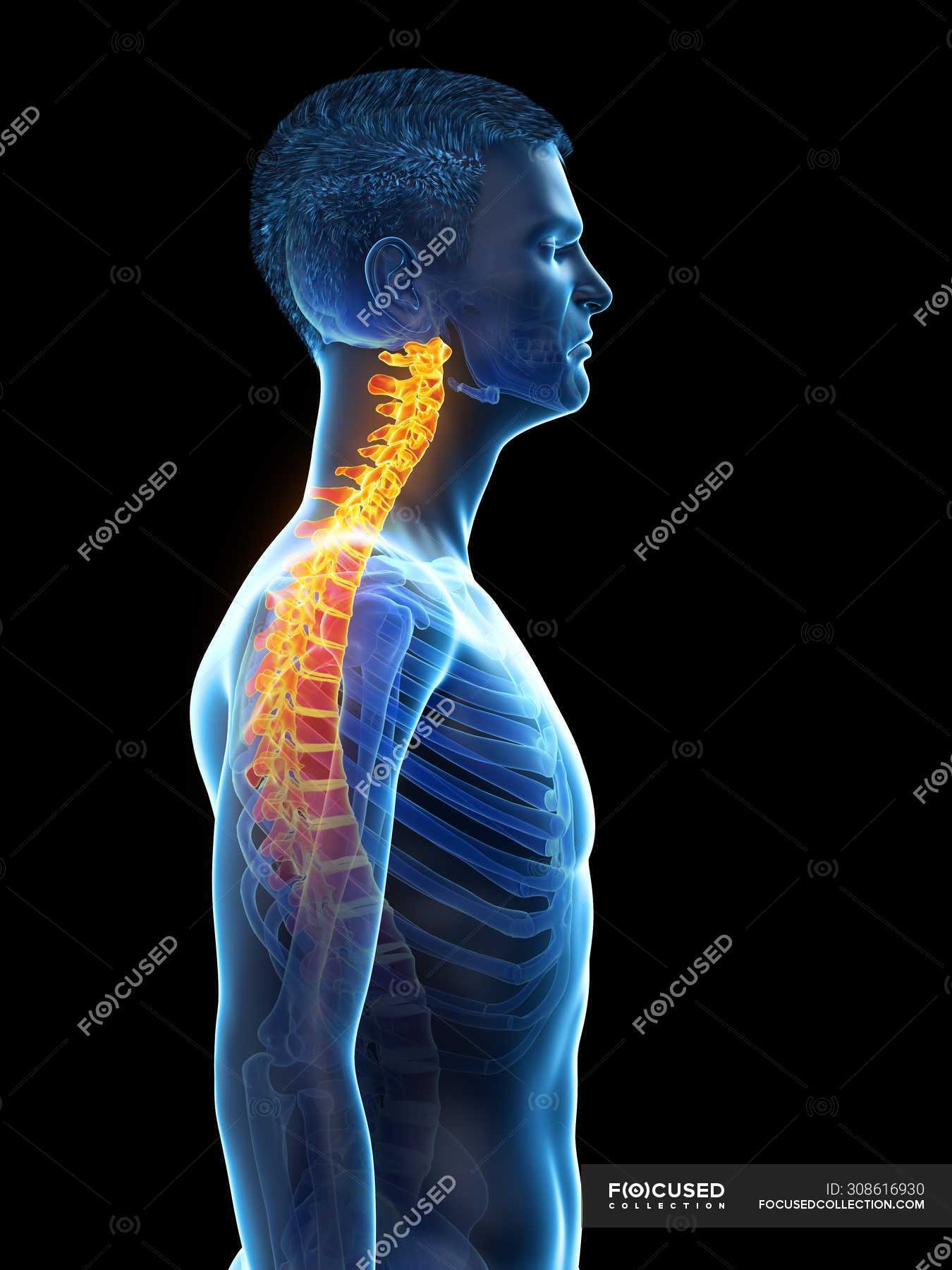 Male silhouette with neck pain, conceptual illustration. — inflammation ...