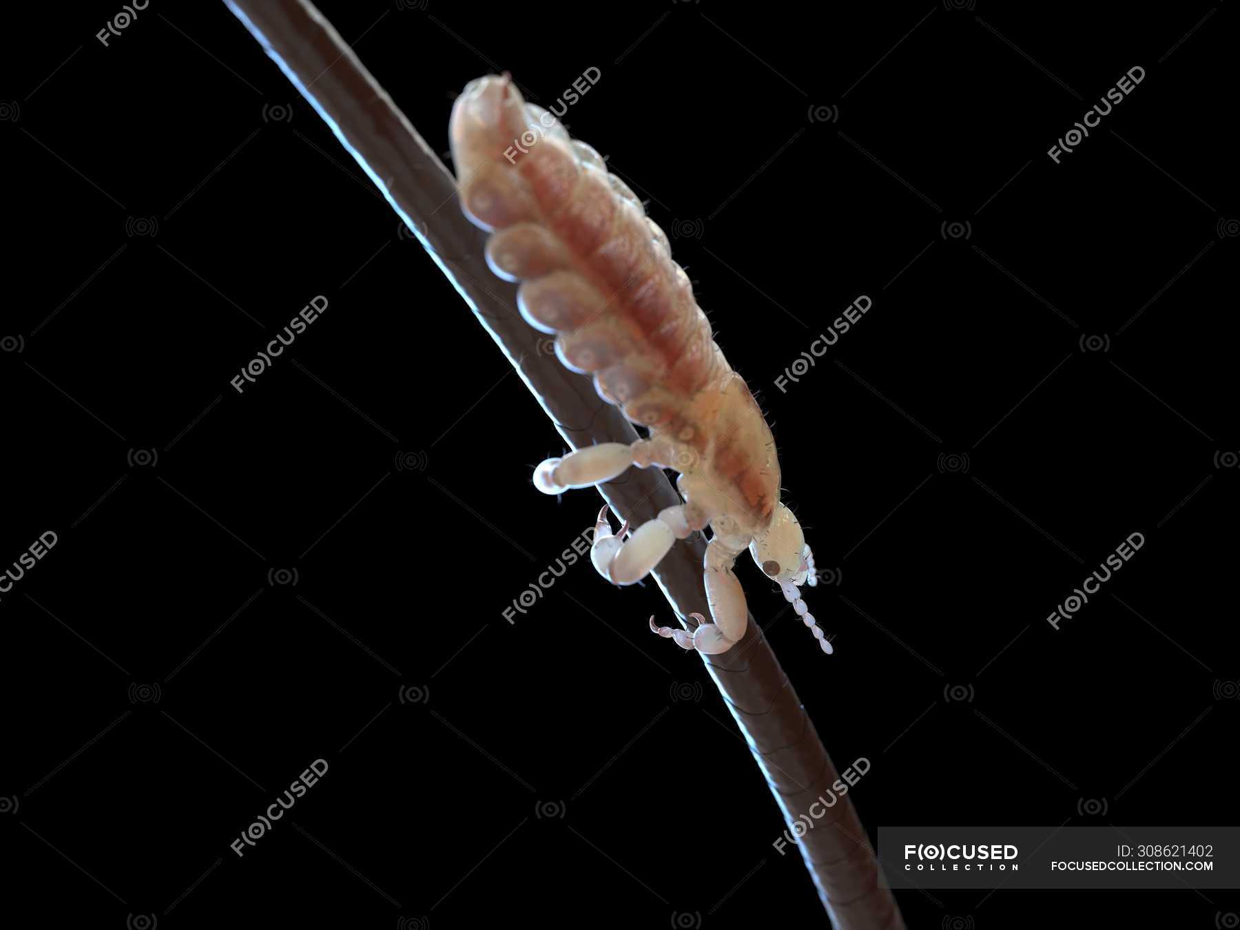 What Is Head Lice Symptoms Causes Diagnosis Treatment and Prevention   Everyday Health