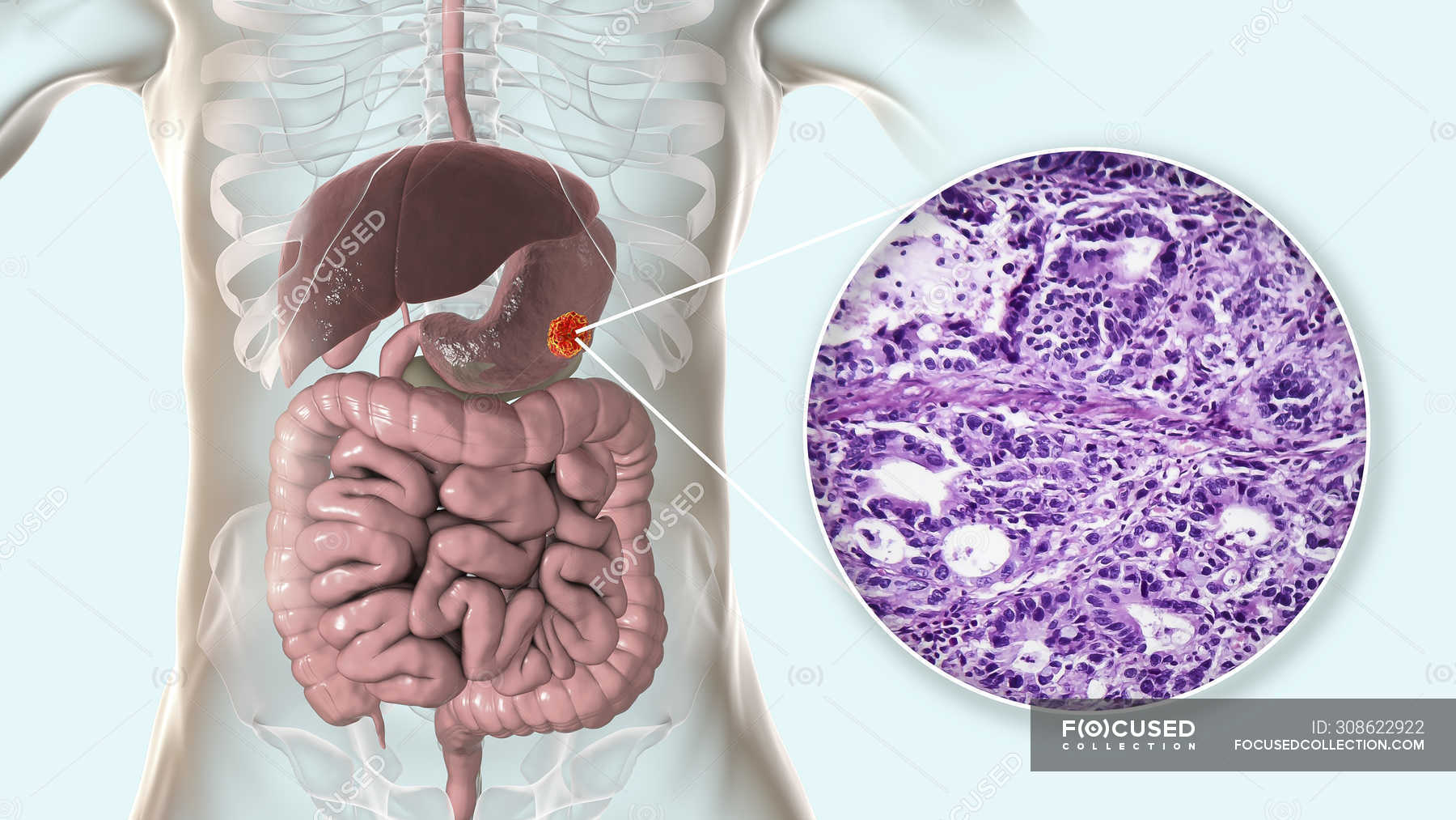 Human Stomach Adenocarcinoma Computer Illustration And Light