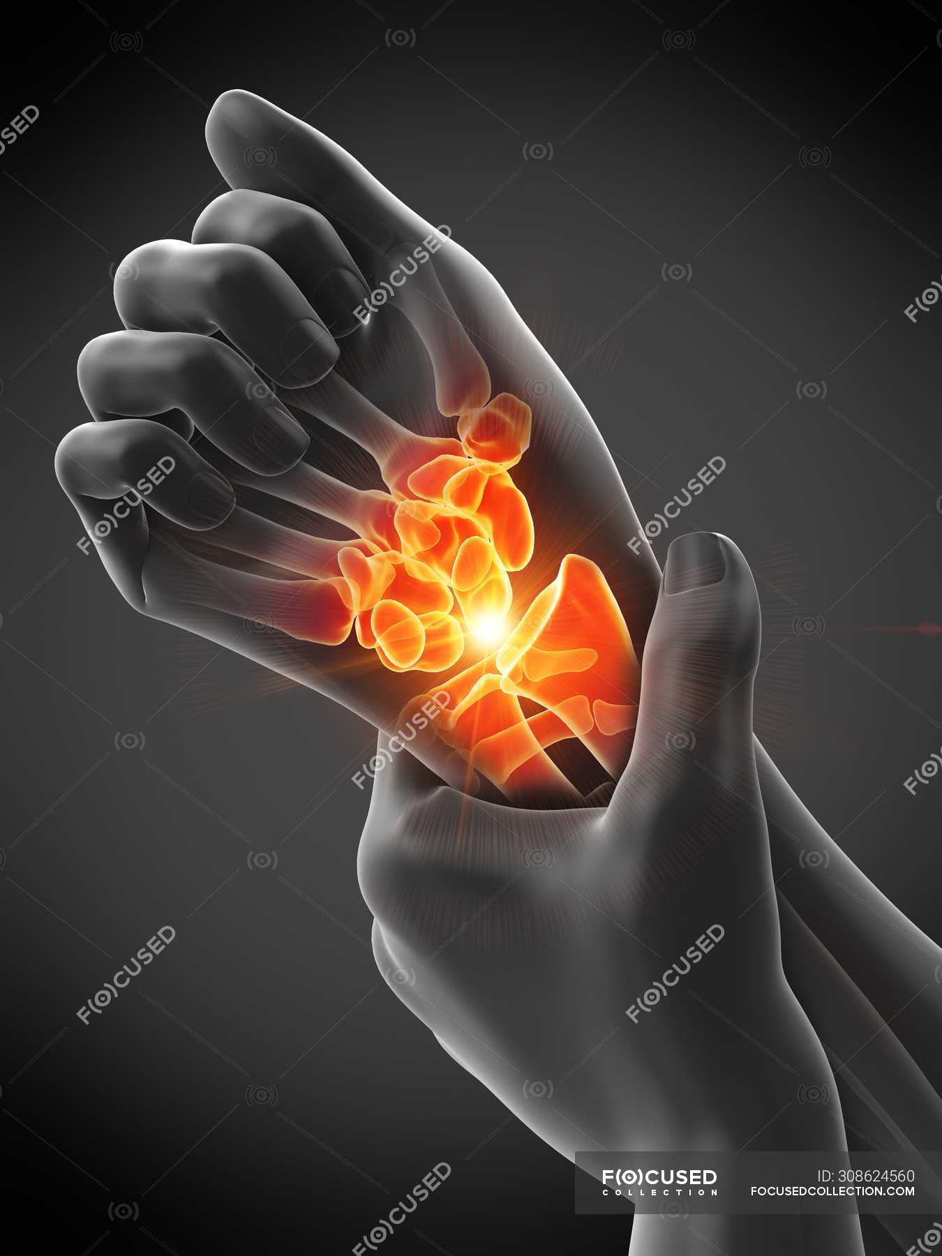 Abstract Human Hands With Wrist Pain Conceptual Illustration   Focused 308624560 Stock Photo Abstract Human Hands Wrist Pain 