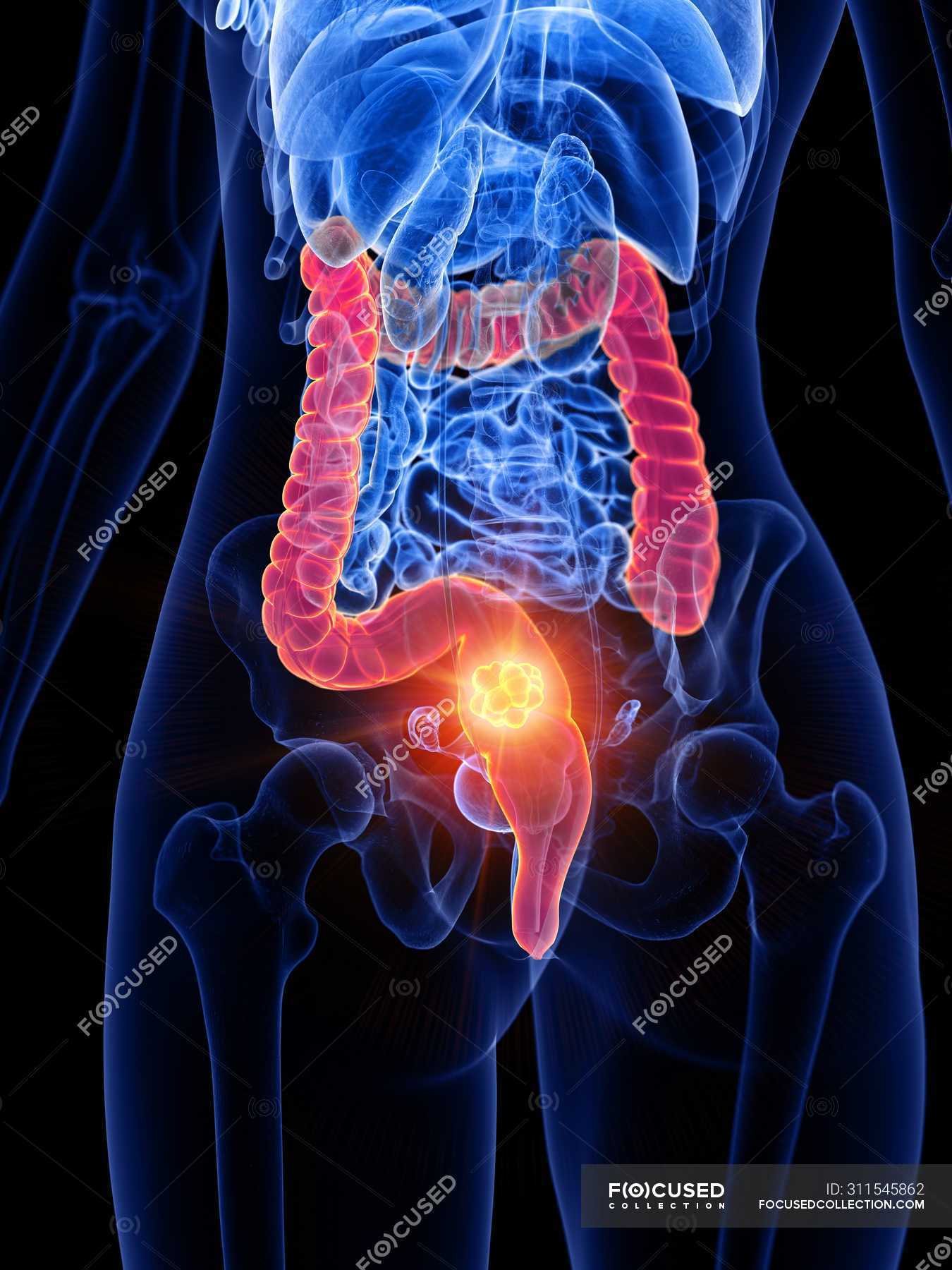 Bowel cancer in female body, conceptual computer illustration. — colon ...