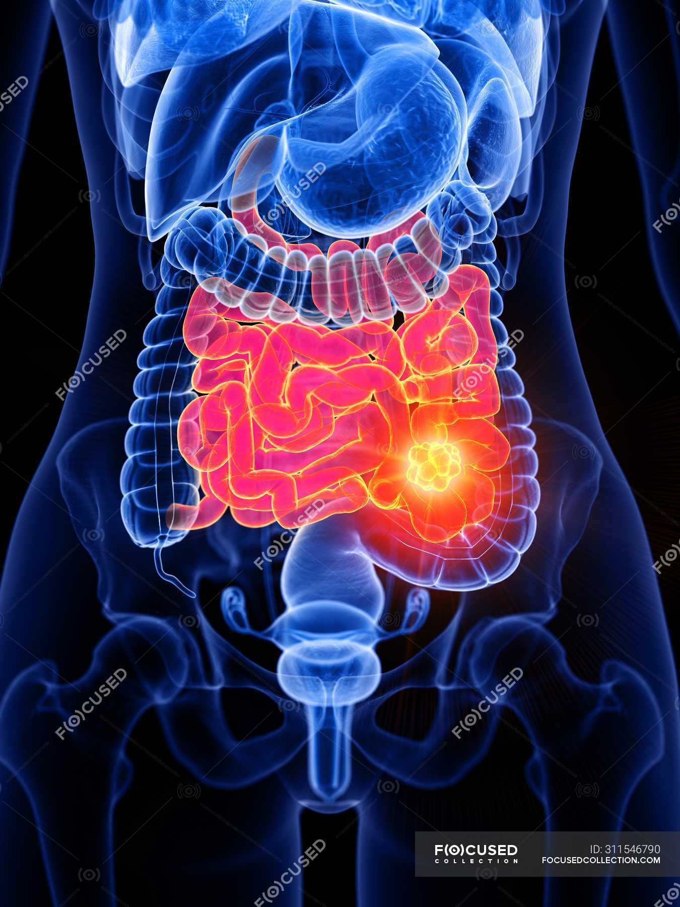 Small intestine and bowel cancer in female body, conceptual computer ...