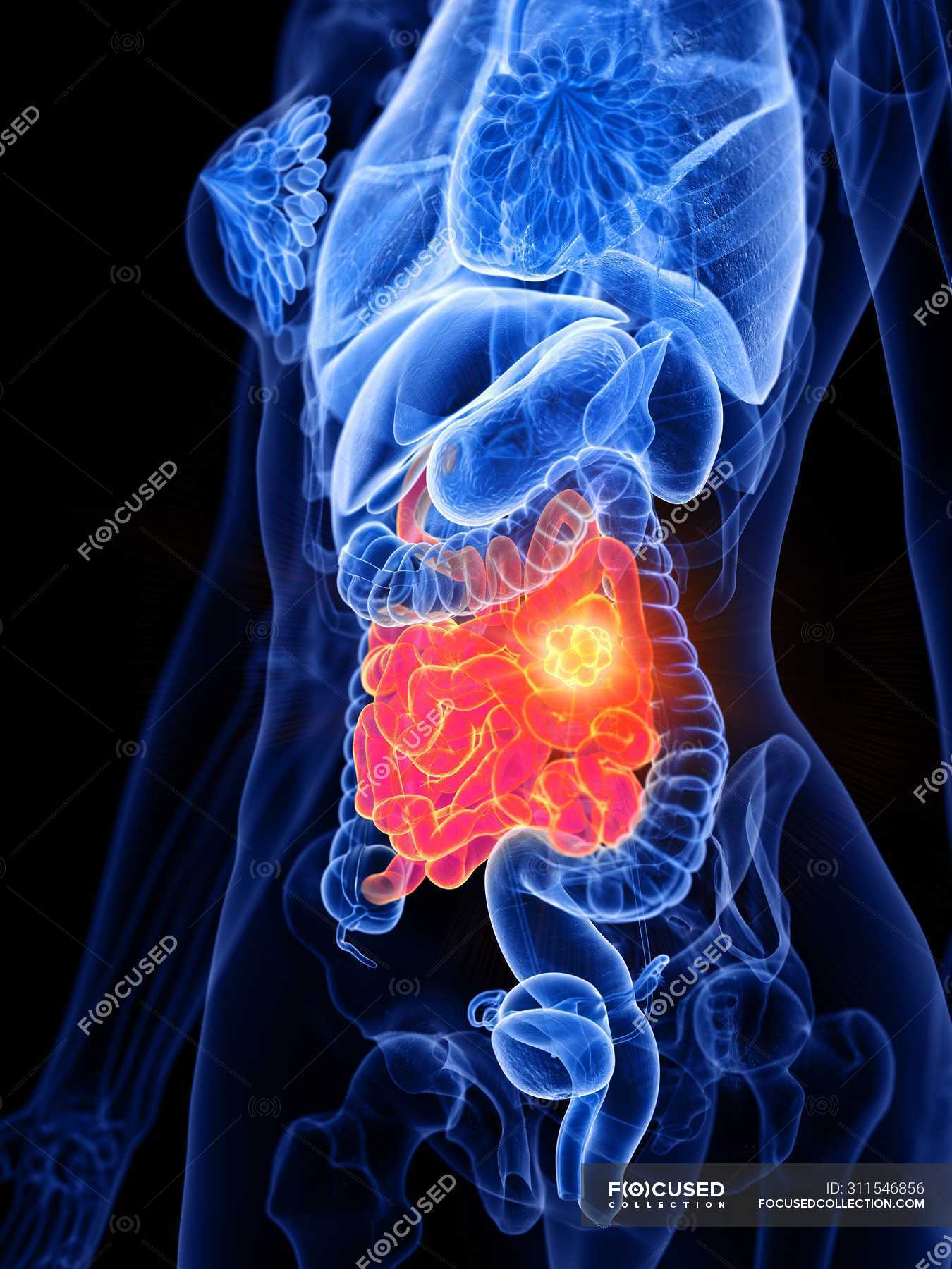 Small intestine and bowel cancer in female body, conceptual computer ...