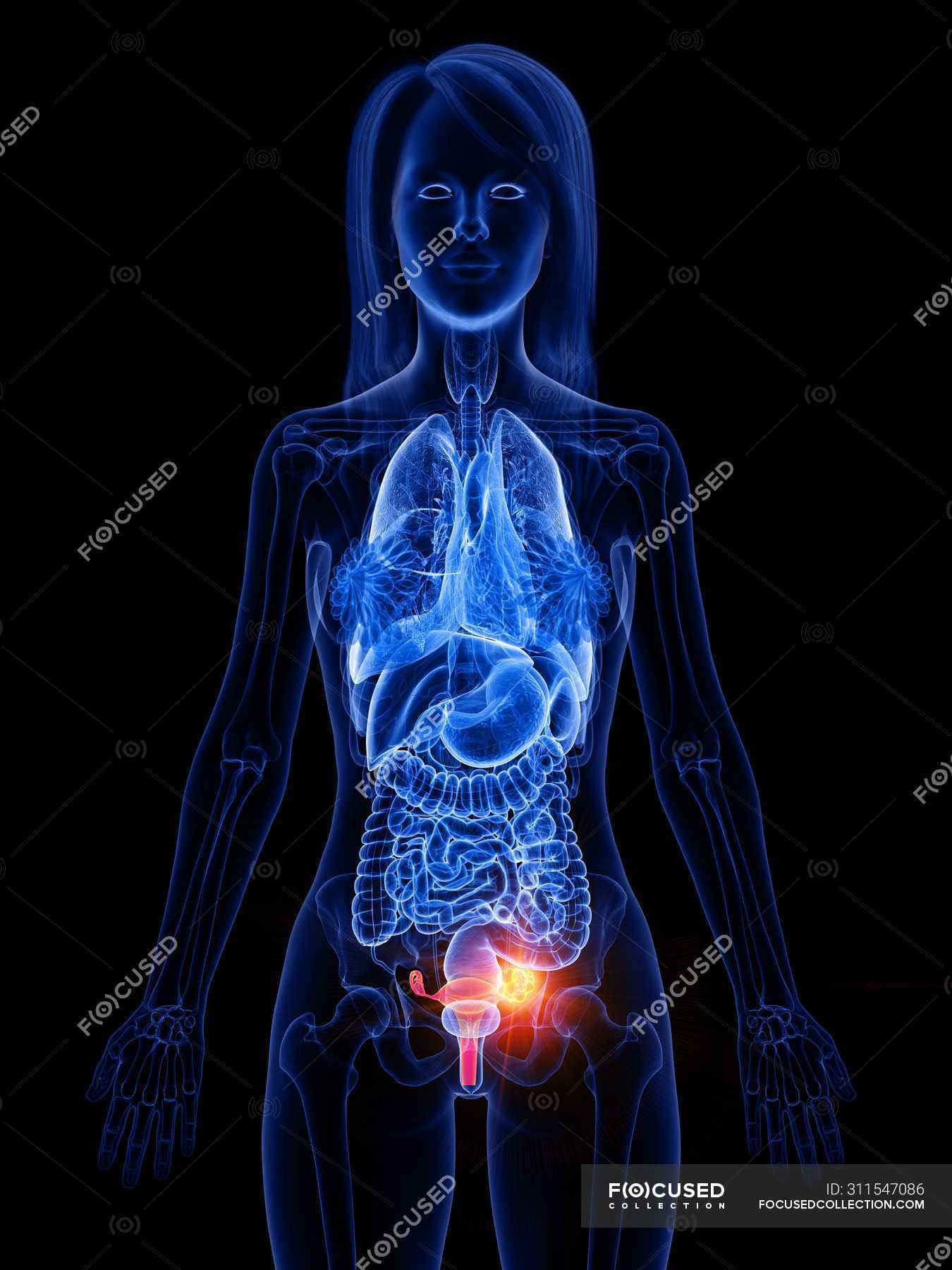 Uterine cancer in female body, conceptual computer illustration ...