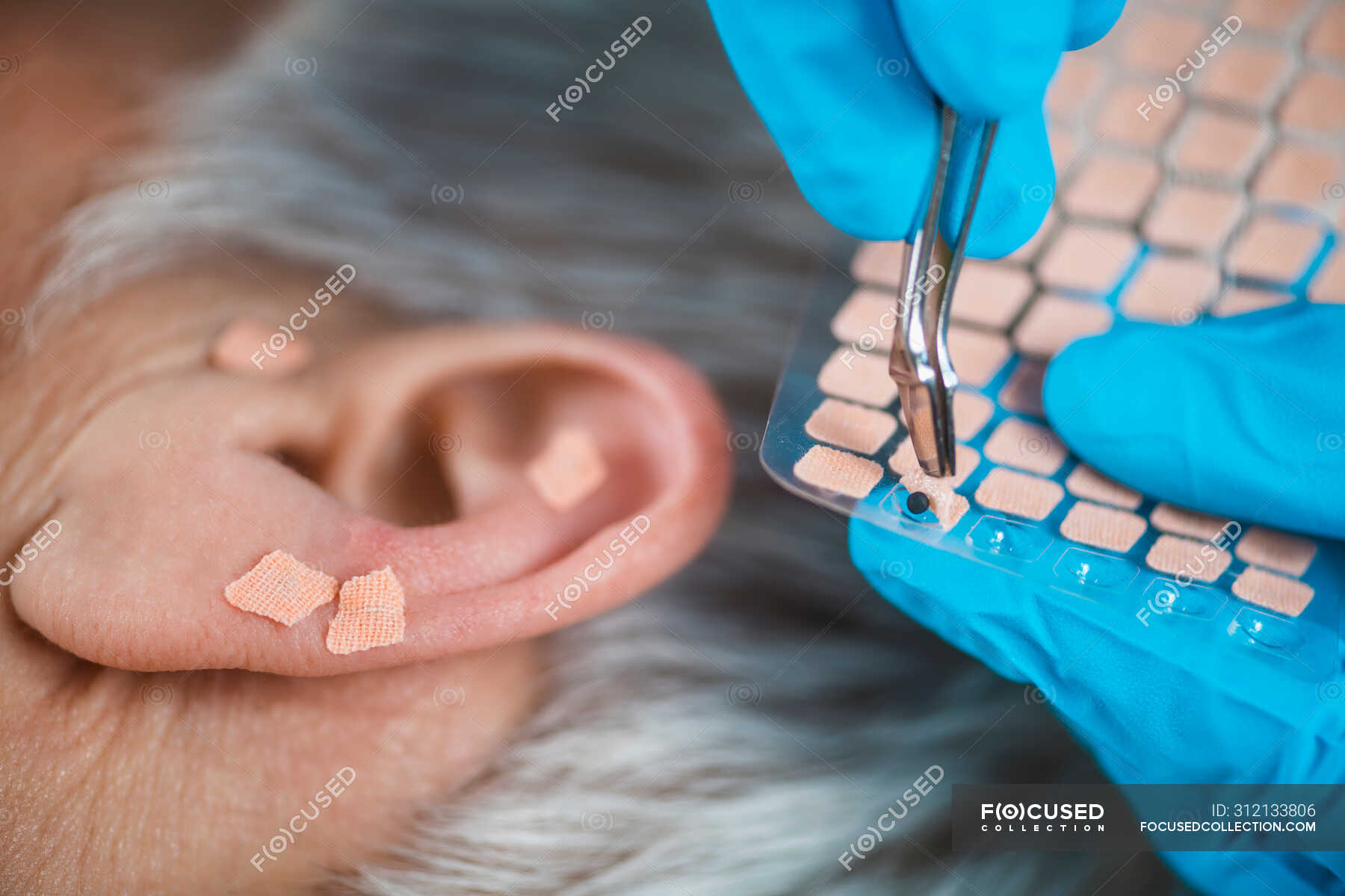 Auriculotherapy, or auricular treatment on human ear, close up