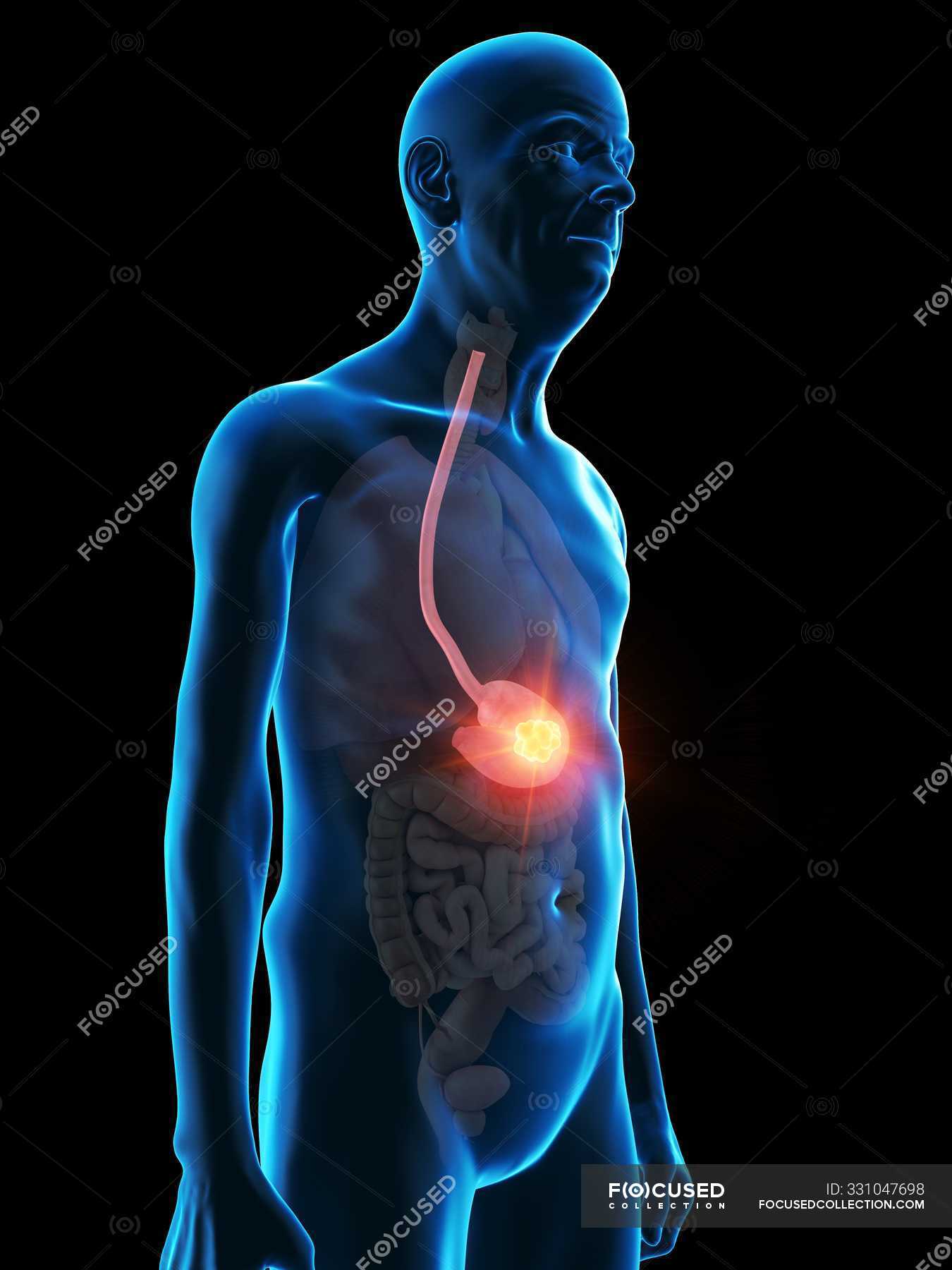 Digital Illustration Of Senior Man Anatomy Showing Stomach Tumour Artwork Abnormal Stock Photo 331047698