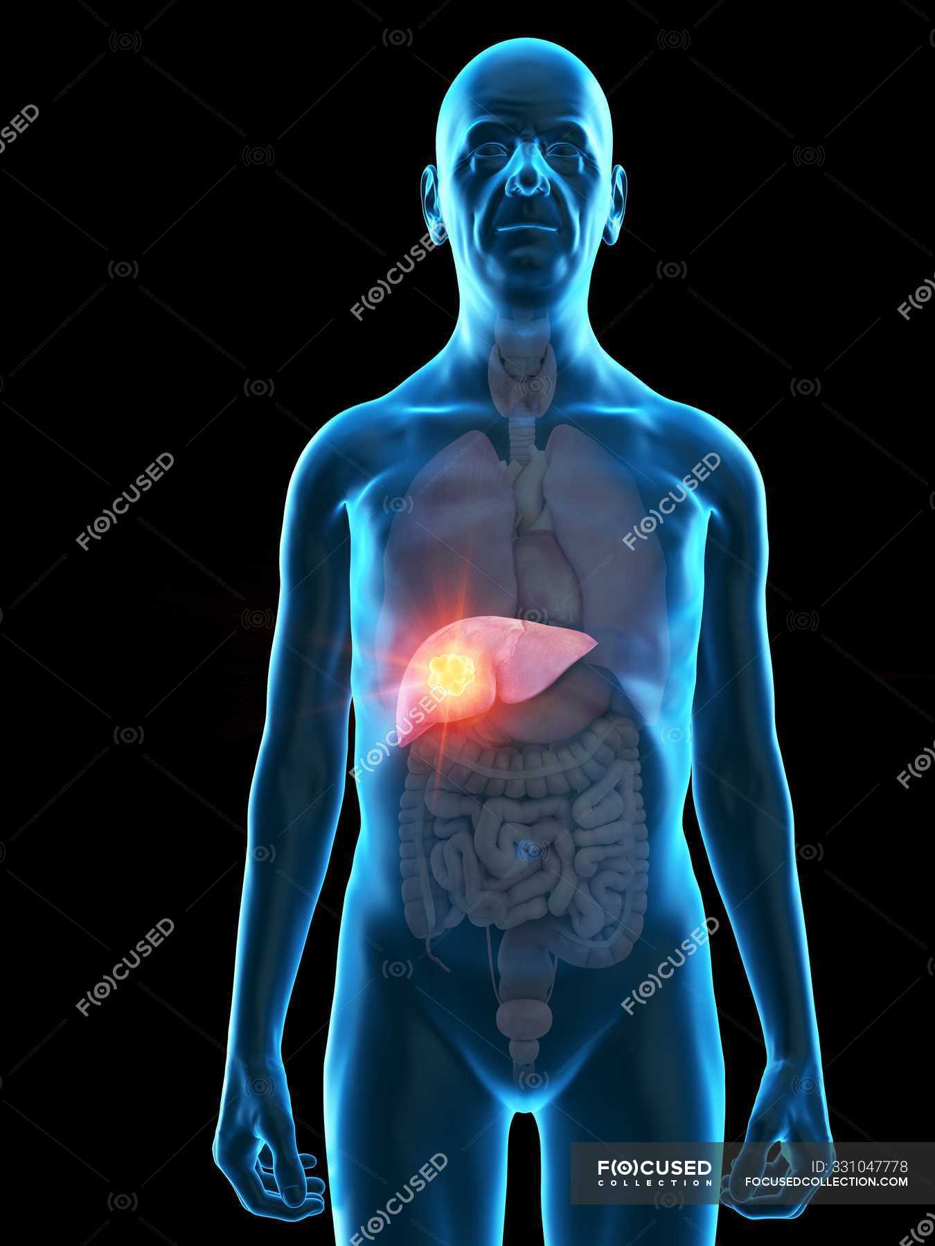 Digital illustration of senior man anatomy showing liver tumour ...