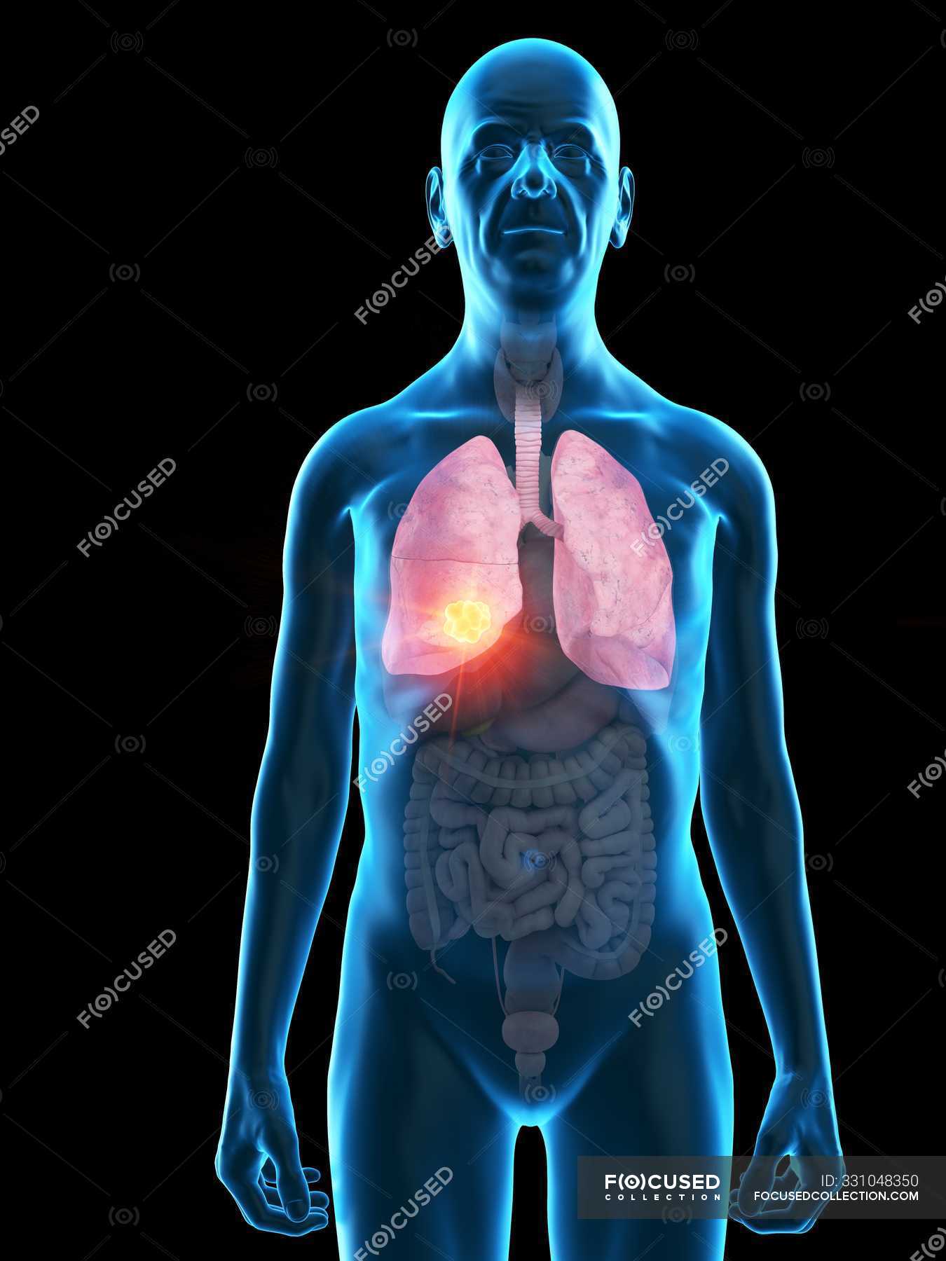 Digital Illustration Of Senior Man Anatomy Showing Lung Tumour Human Anatomy Science Stock Photo 331048350