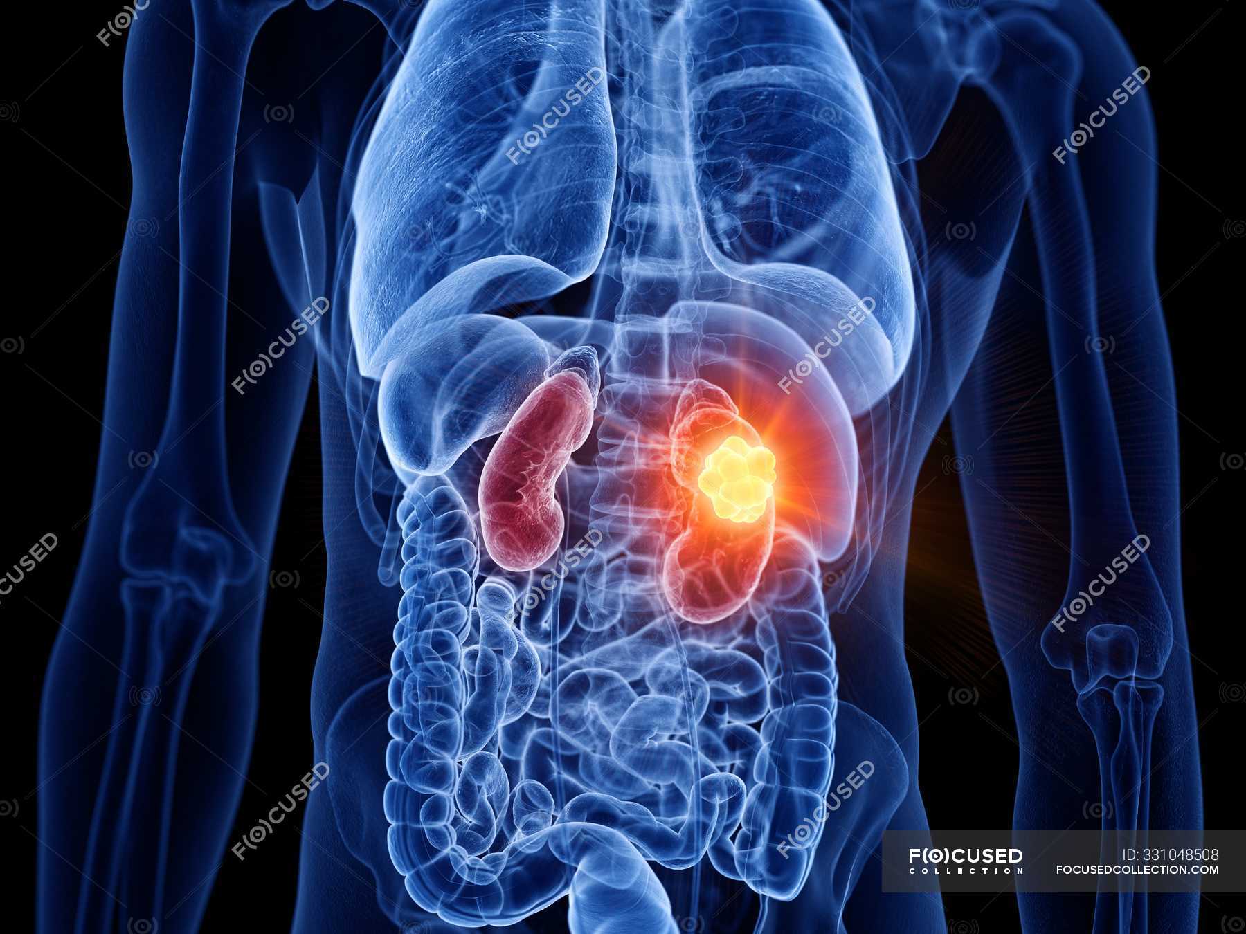 Transparent male body with kidney cancer, digital illustration ...