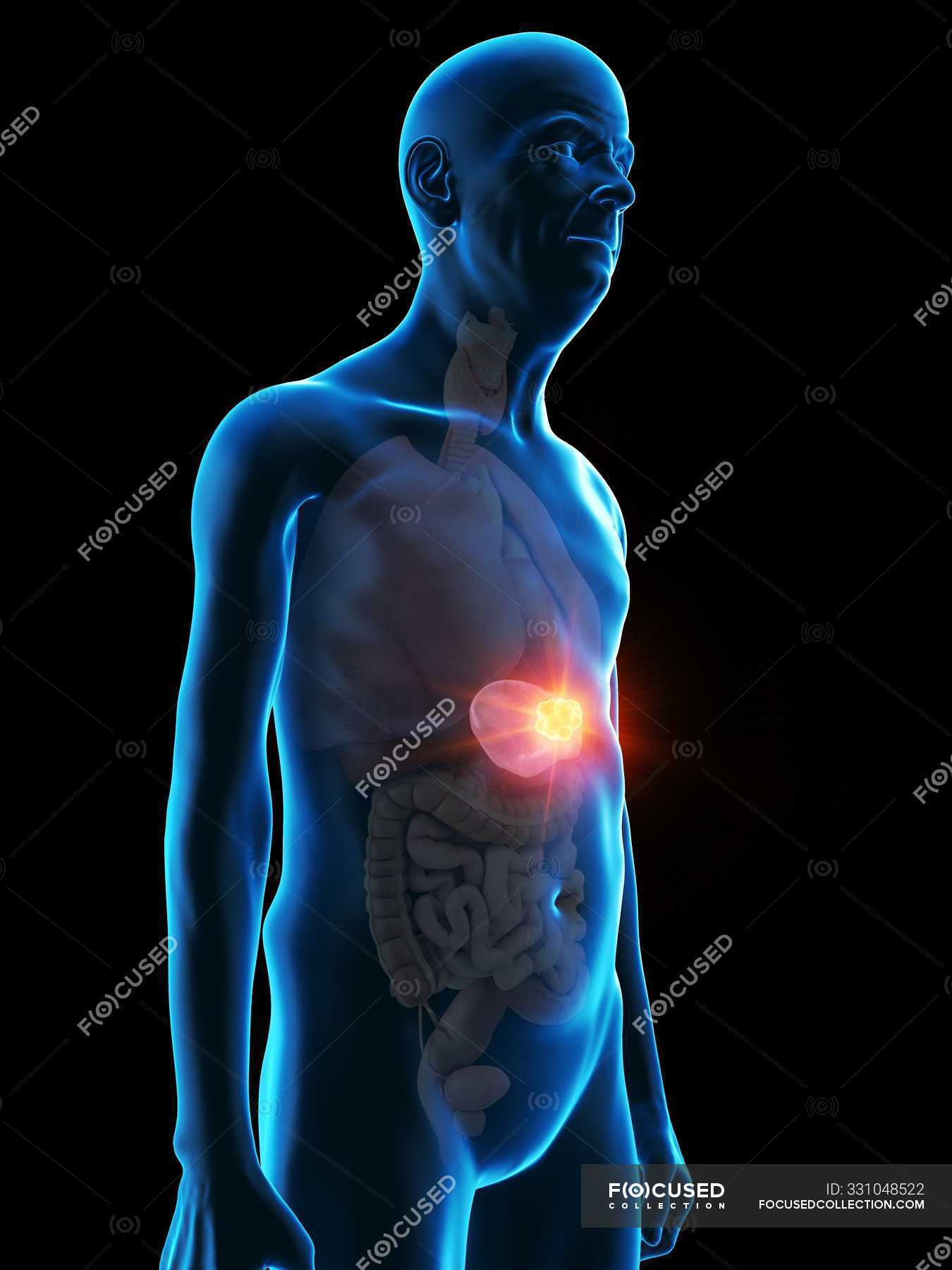 Digital Illustration Of Senior Man Anatomy Showing Spleen Tumour Human Anatomy Visible Stock Photo 331048522