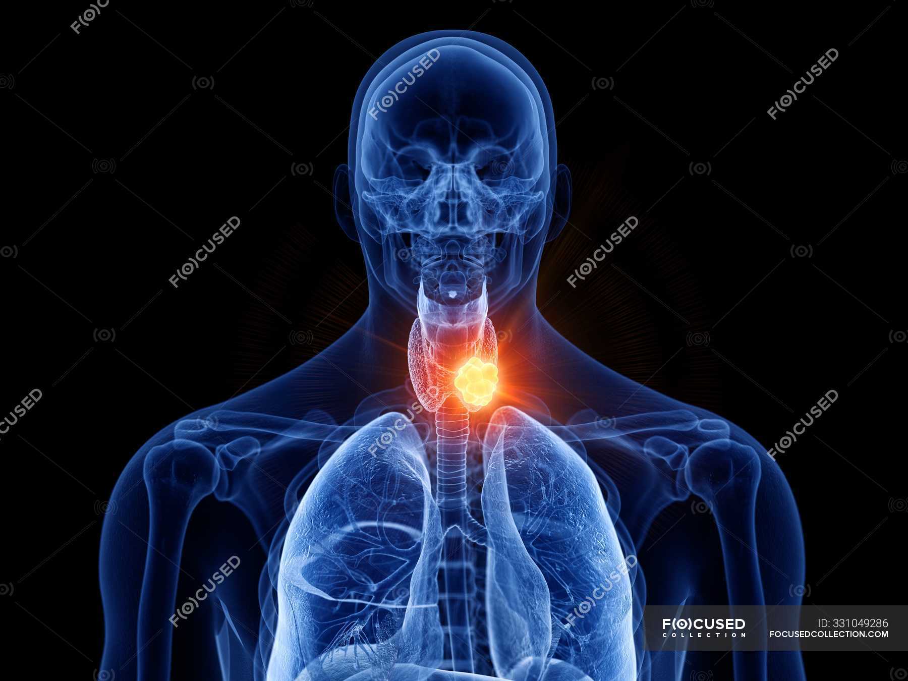 Abstract Transparent Male Body With Glowing Thyroid Cancer Digital Illustration Condition Anatomy Stock Photo 331049286
