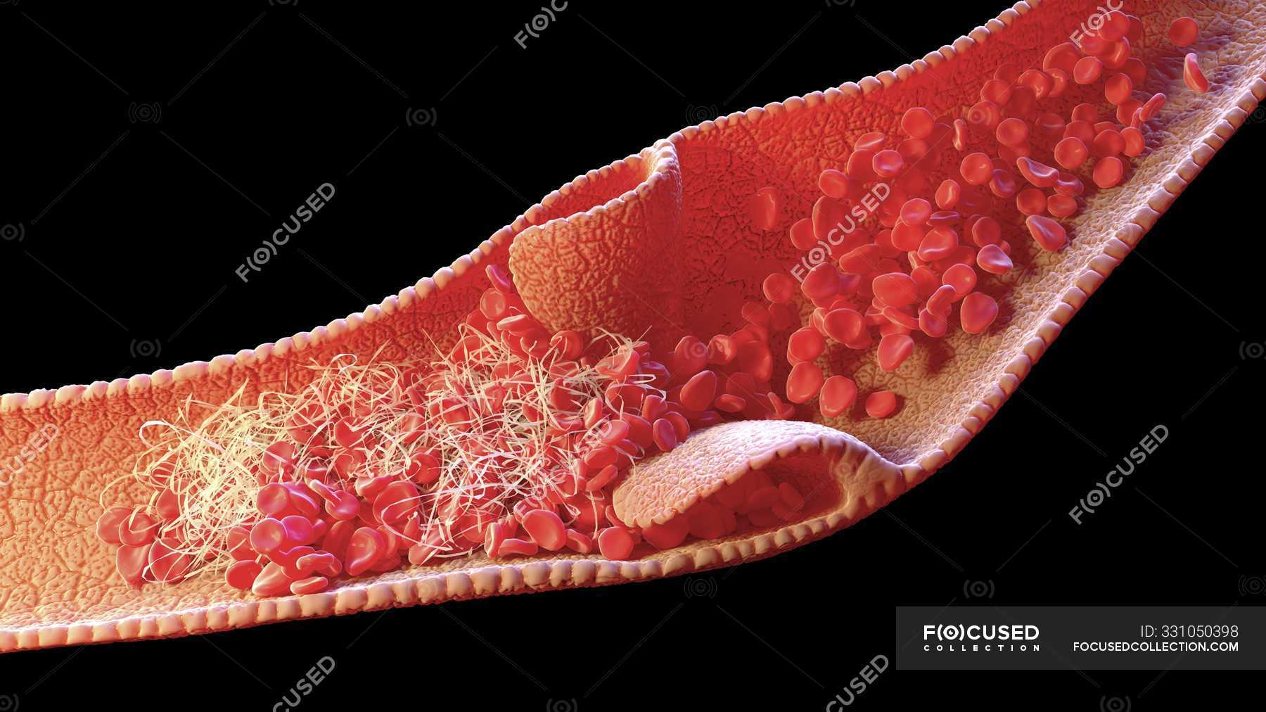 Computerillustration eines blutgerinnsels in der vene, bekannt als