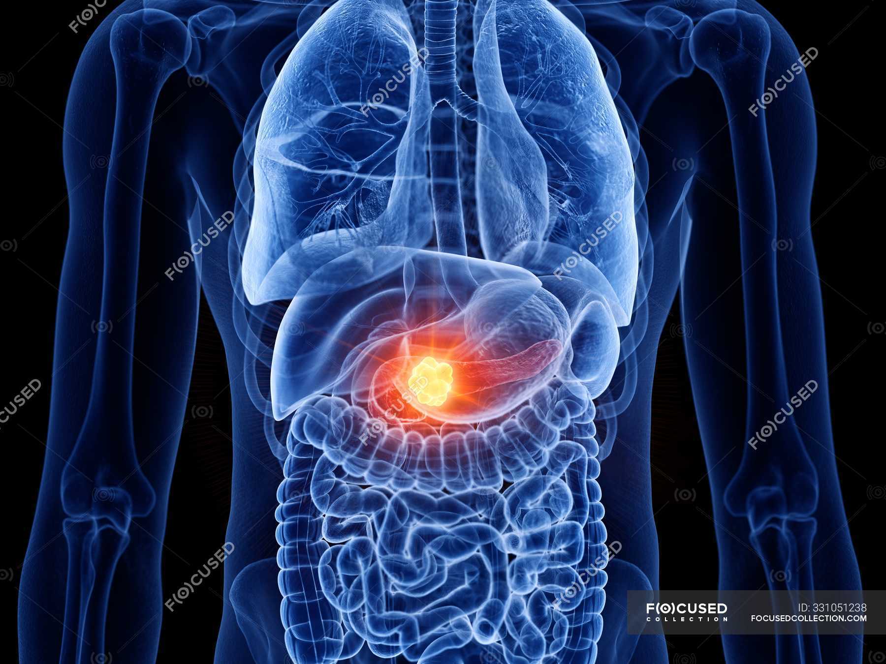 Pancreas cancer in male body, computer illustration. — medical, 3d ...