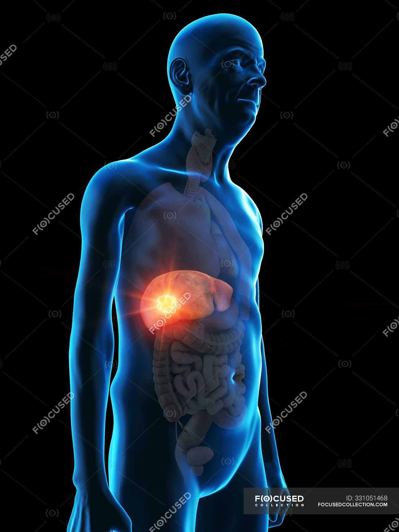 Digital illustration of senior man anatomy showing liver tumour ...