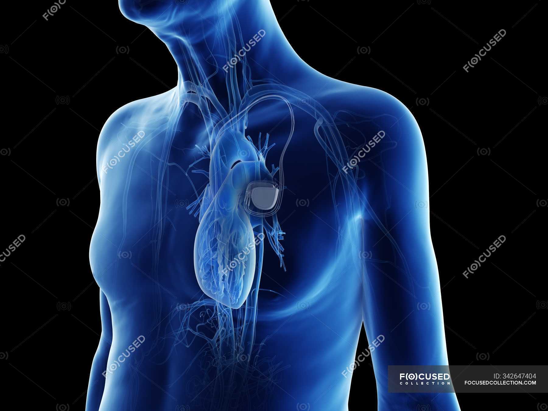 кардиостимулятор сердца видео. имплантация сердца кардиостимулятор. имплантация кардиовертера-дефибриллятора. кардиостимулятор сердца. кардиостимулятор сердца видео.