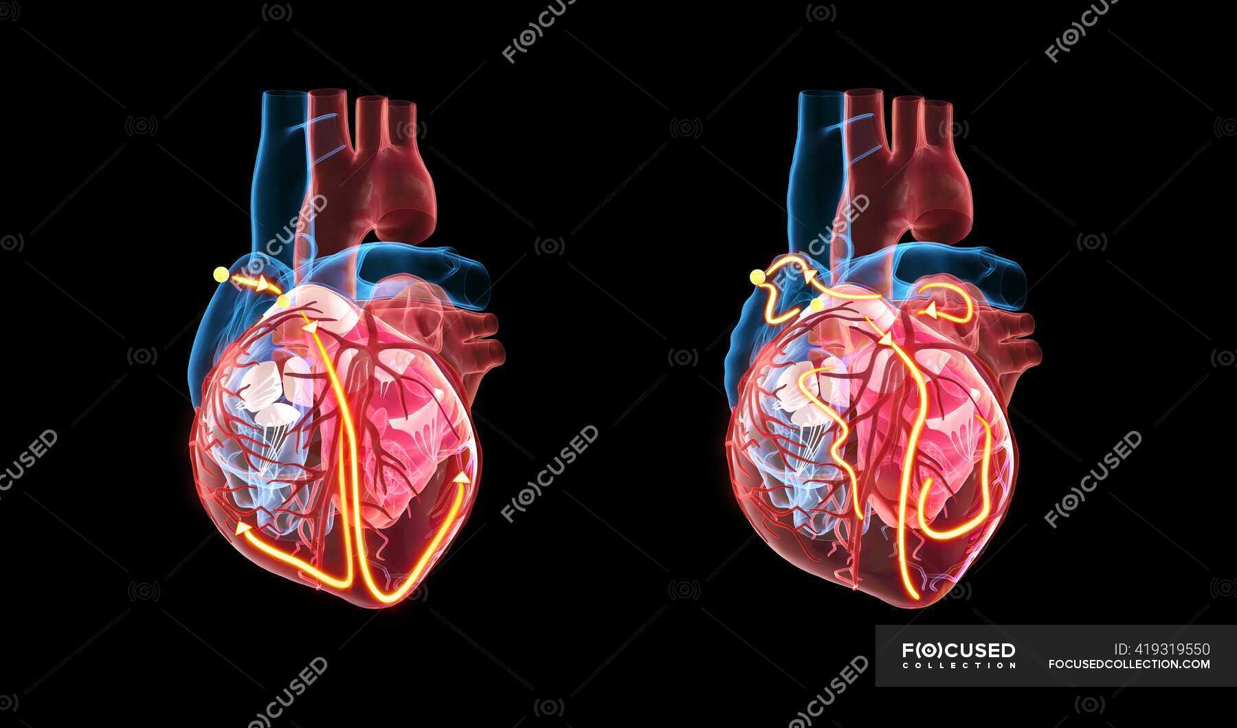 Human heart and its electrical system, 3d illustration. The yellow lines  demonstrate the electrical (conduction) system of the heart. The heart at  right shows an irregular heartbeat (arrhythmia) and atrial fibrillation. —