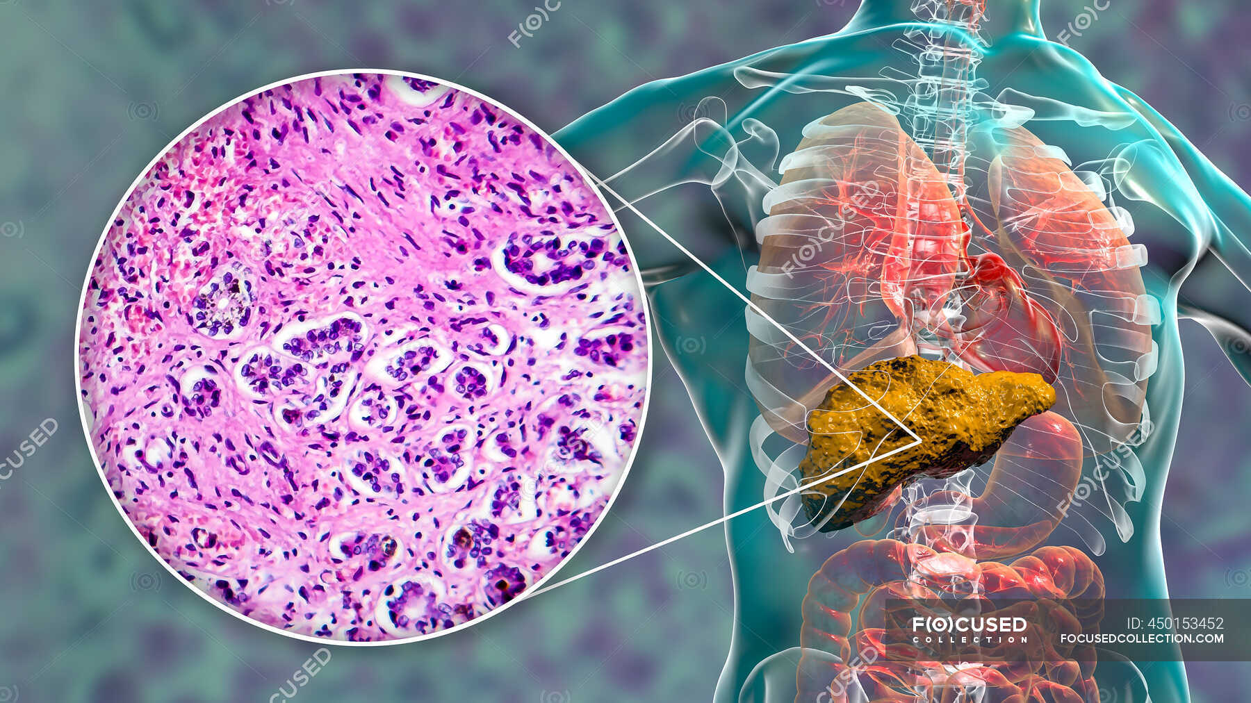 liver-cirrhosis-computer-illustration-and-light-micrograph-of-a