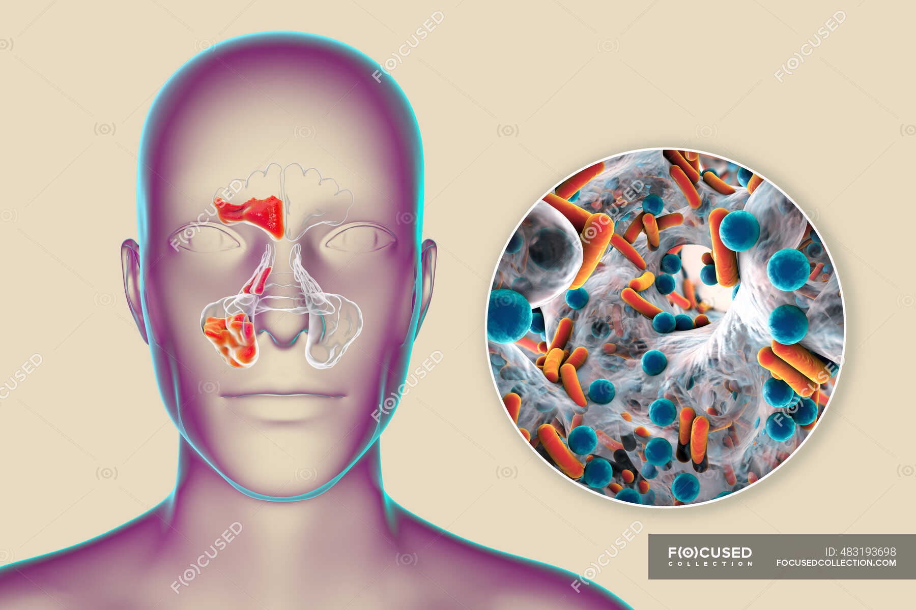 Sinusitis Bacteriana Ilustración Por Computadora Los Senos