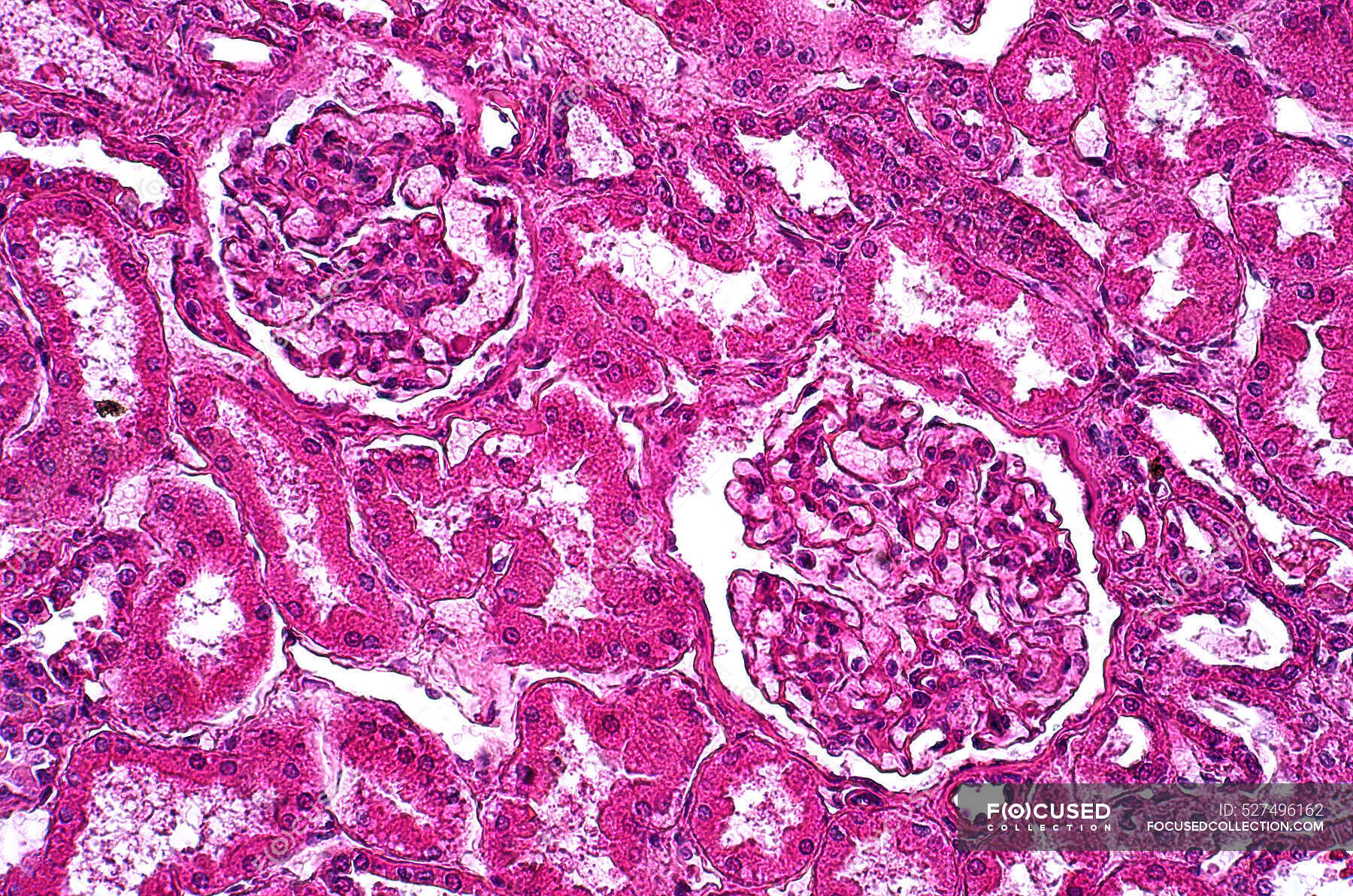 Micrografía ligera de una sección a través del hígado de un paciente