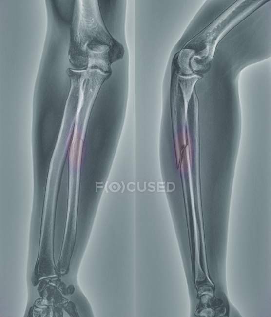 Röntgenbild des Arms einer 20-jährigen Patientin mit gebrochenem Radius (Unterarmknochen)). — Stockfoto
