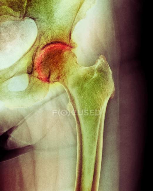 Artrite da articulação da anca — Fotografia de Stock