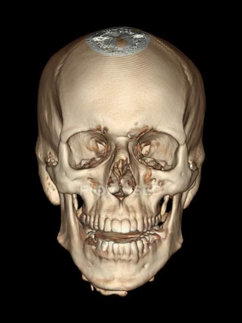 Anatomía normal del cráneo de adultos jóvenes - foto de stock