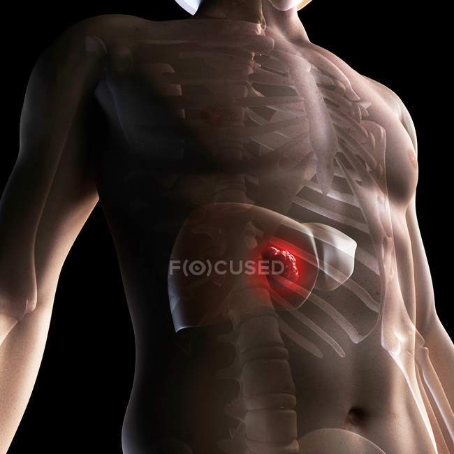 Liver cancer pathology — Stock Photo