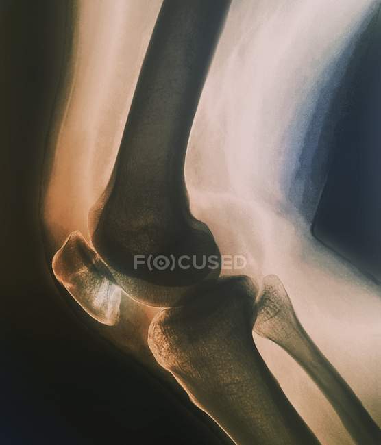 Raio-X da patela fracturada — Fotografia de Stock