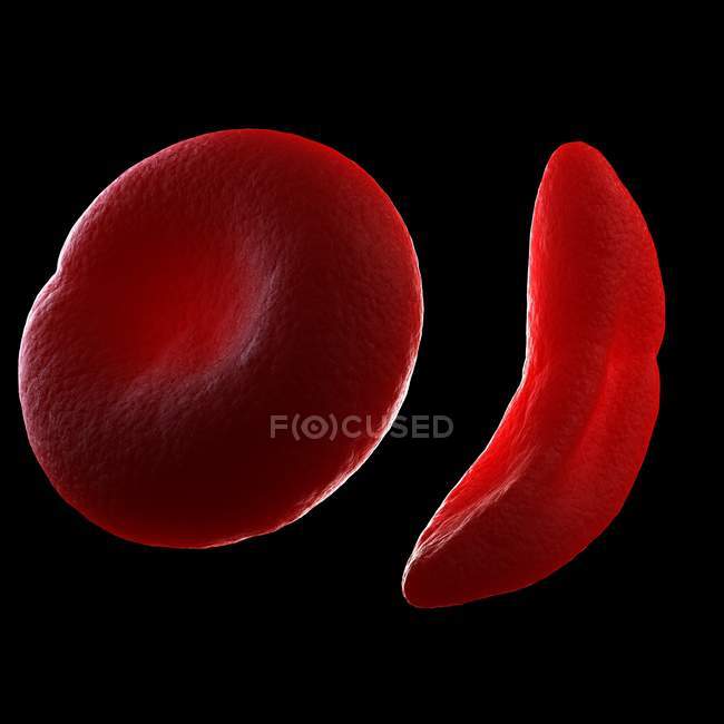 Anemia falciforme — Fotografia de Stock