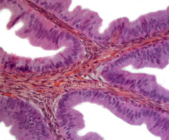 Micrografía ligera de una sección a través de un pólipo nasal, un crecimiento benigno que surge de una membrana mucosa
. - foto de stock