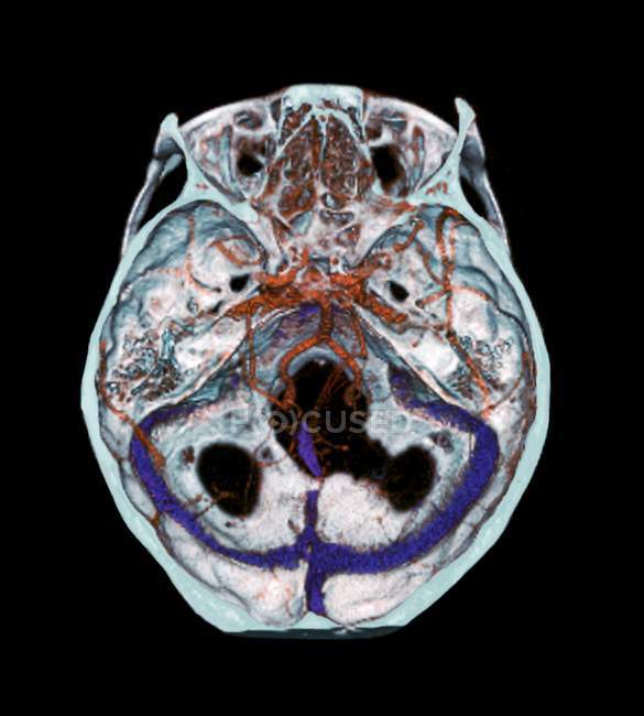 Tomografia computadorizada 3D (CT) varredura de artérias normais no cérebro de um 35 anos de idade . — Fotografia de Stock