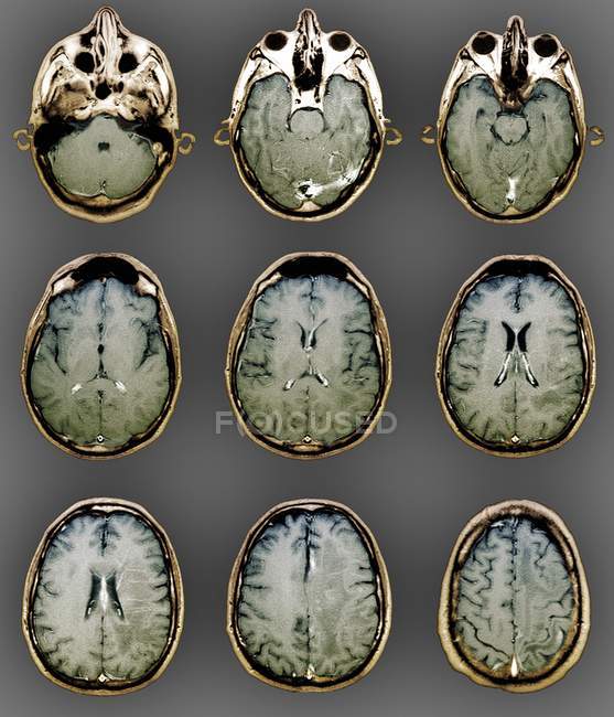 Colored magnetic resonance imaging scans of healthy brain of patient. — Stock Photo
