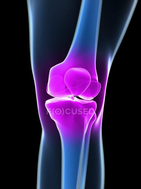 Articolazione del ginocchio con focalizzazione localizzata dell'infiammazione — Foto stock
