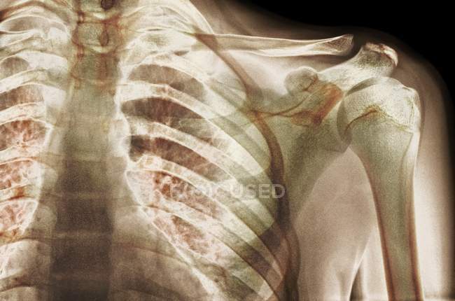 Normal shoulder girdle — Stock Photo