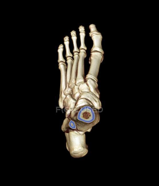 Цветная трехмерная компьютерная томография (КТ) здоровой стопы 23-летнего пациента . — стоковое фото