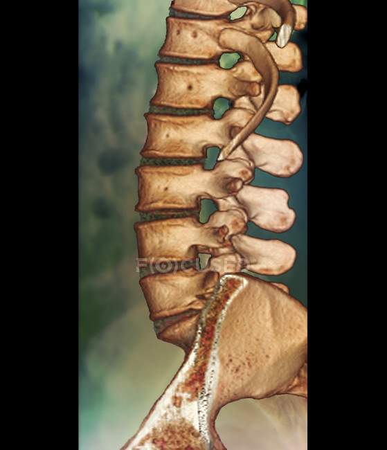 Colored computed tomography scan of lumbar spine. — Stock Photo