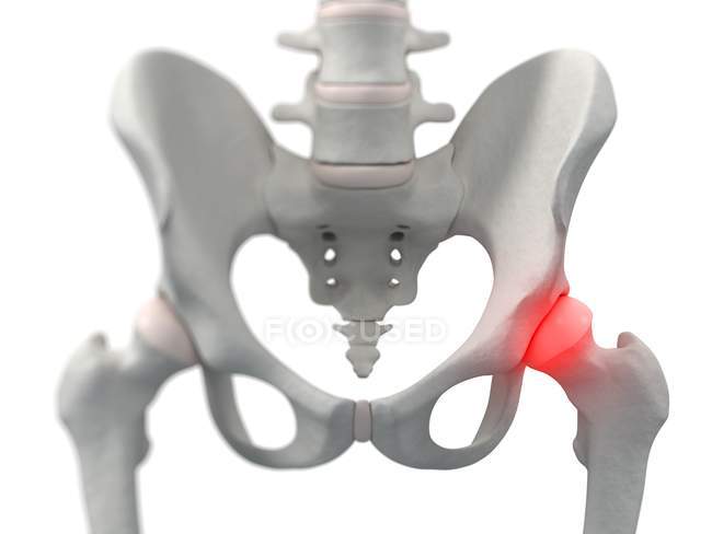Concentration de l'inflammation localisée dans l'articulation de la hanche — Photo de stock
