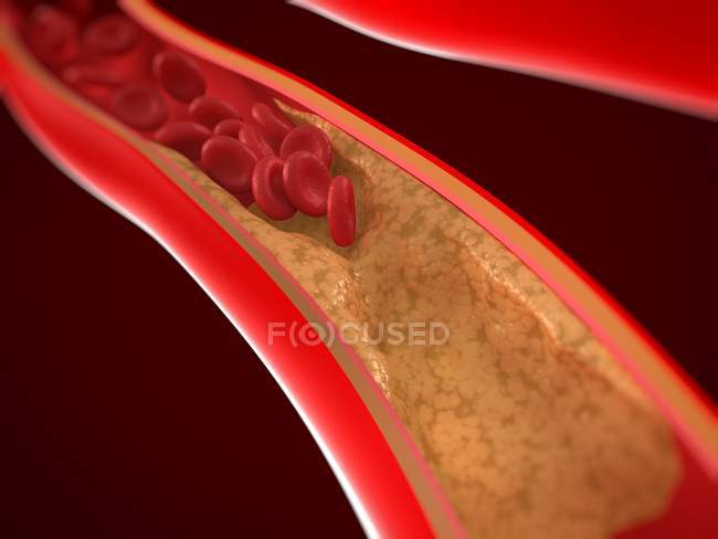 Arteria parzialmente bloccata da ateroma — Foto stock