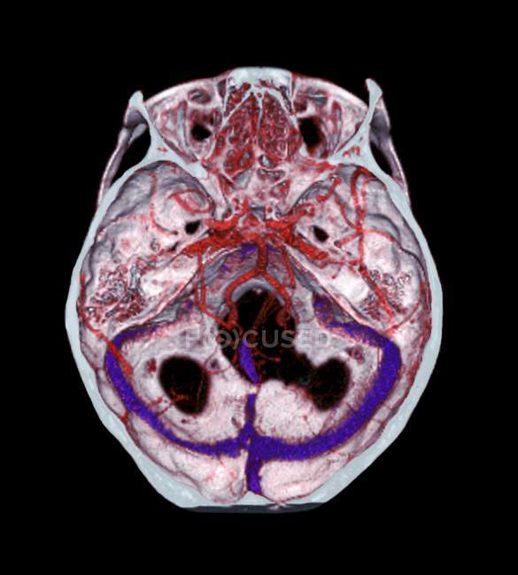 3D компьютерной томографии (КТ) сканирование нормальных артерий в мозгу 35-летнего
. — стоковое фото