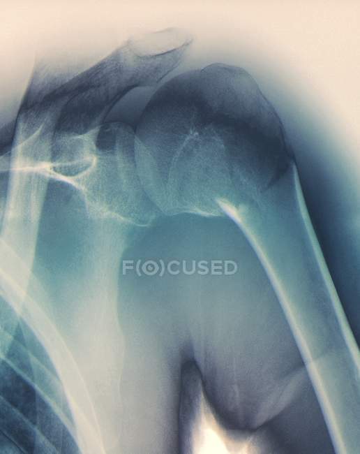 Рентген сломанного плеча — стоковое фото