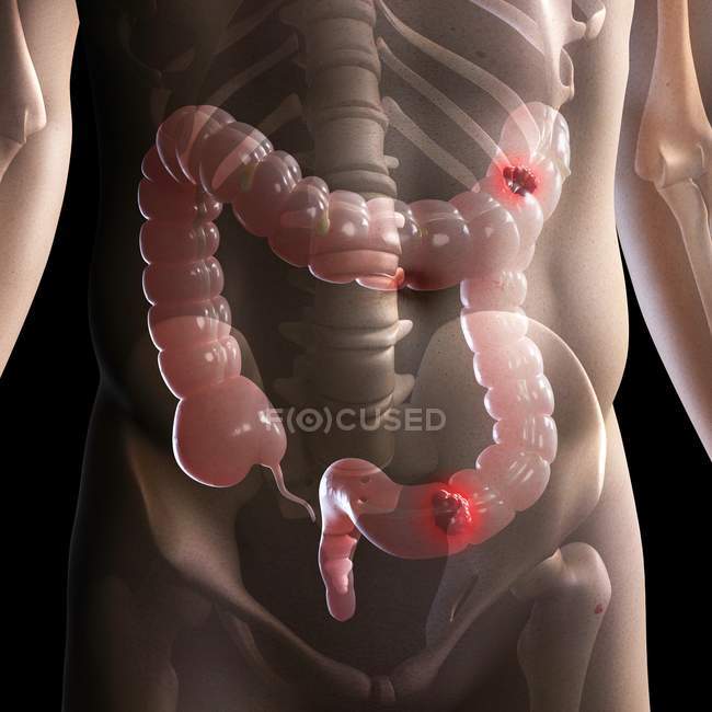 Patología del cáncer intestinal - foto de stock