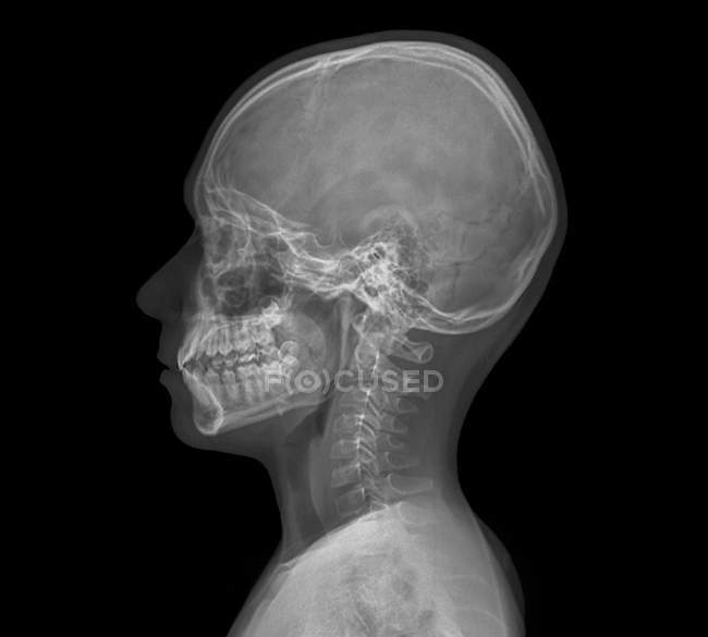 Tête d'enfant normale. Radiographie de la tête d'un enfant de 13 ans
. — Photo de stock