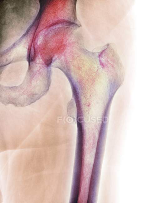 Articulation de hanche saine — Photo de stock