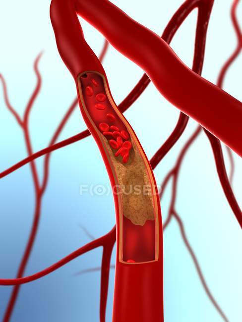 Arterie teilweise durch Atherom blockiert — Stockfoto
