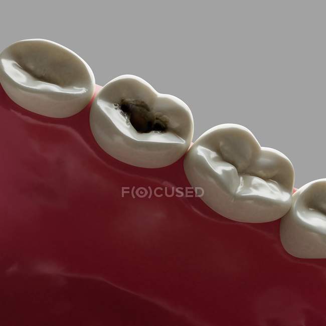 Œuvre d'art d'une dent avec cavités — Photo de stock